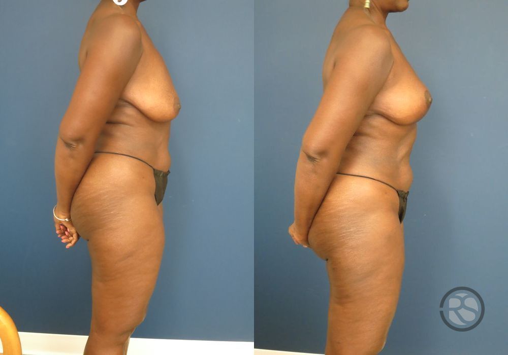 Before photo - Angle 3