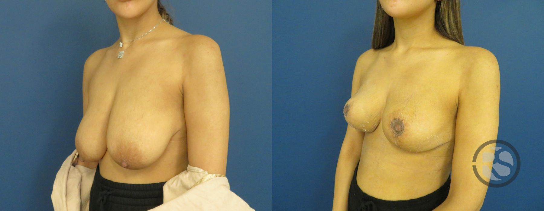 Before photo - Angle 4