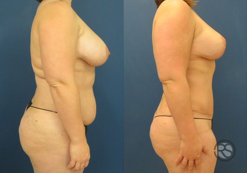 Before photo - Angle 3