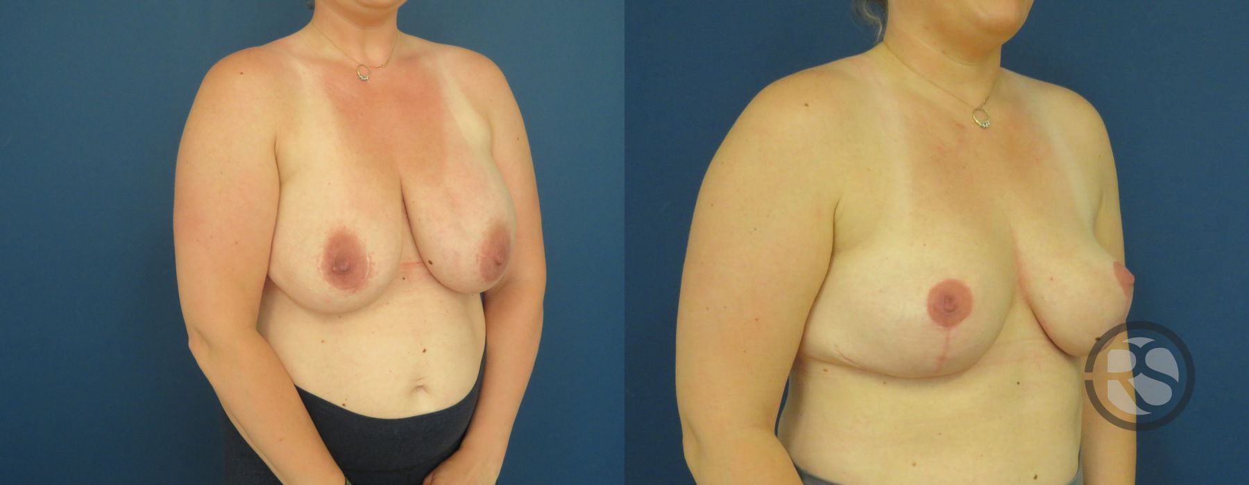 Before photo - Angle 2