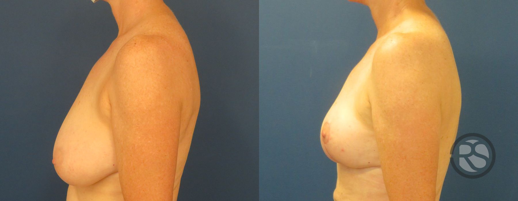 Before photo - Angle 5