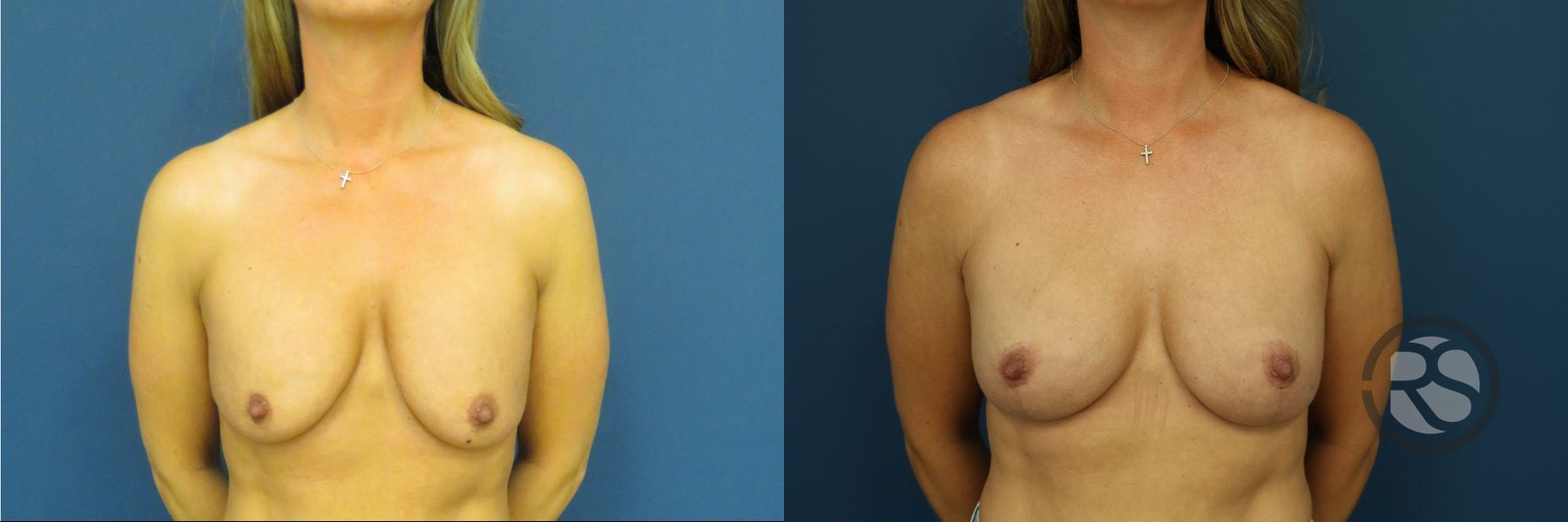 Before and after Breast Lift (Mastopexy) case 46279