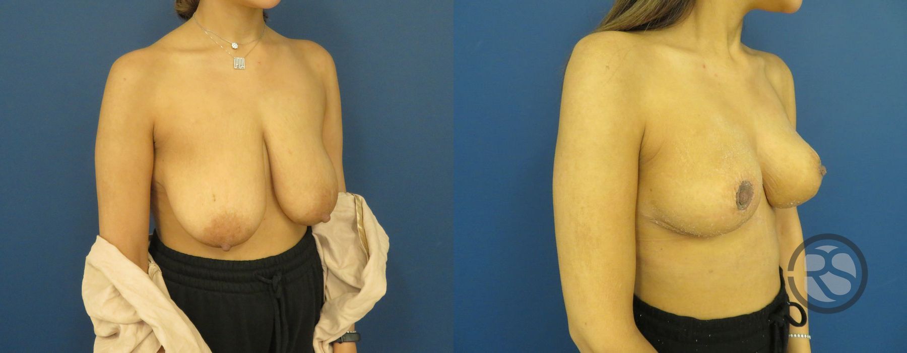 Before photo - Angle 2