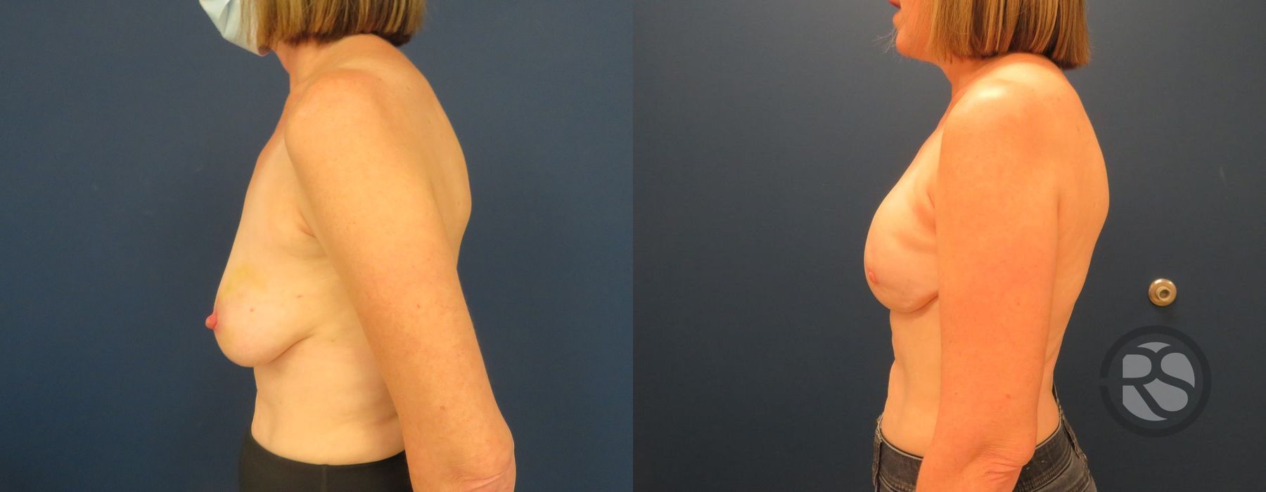 Before photo - Angle 5