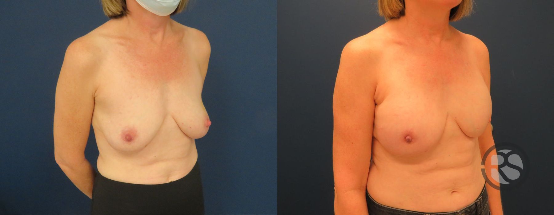 Before photo - Angle 2