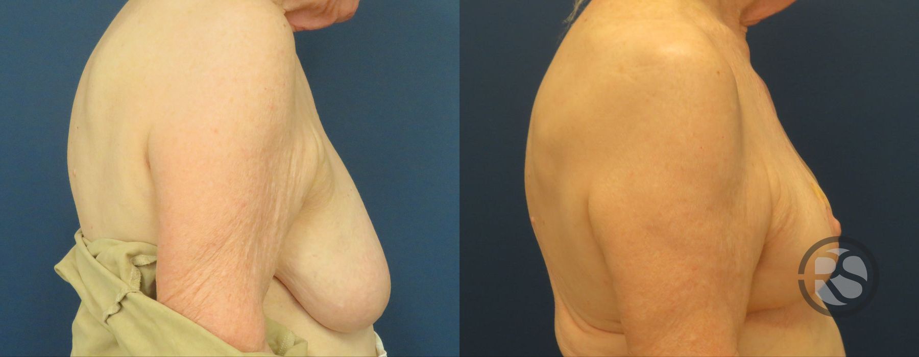 Before photo - Angle 3