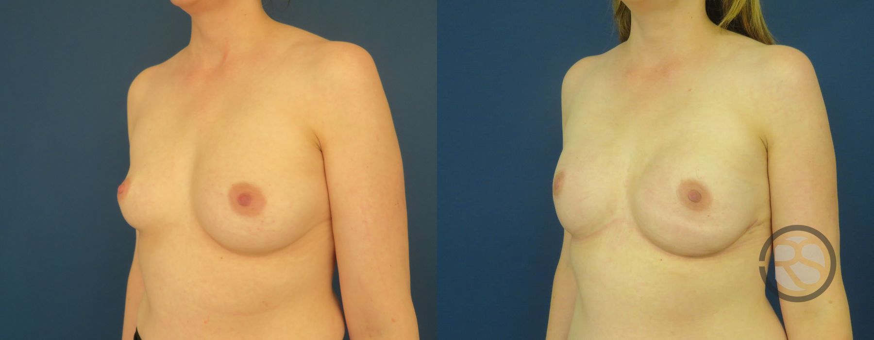 Before photo - Angle 4