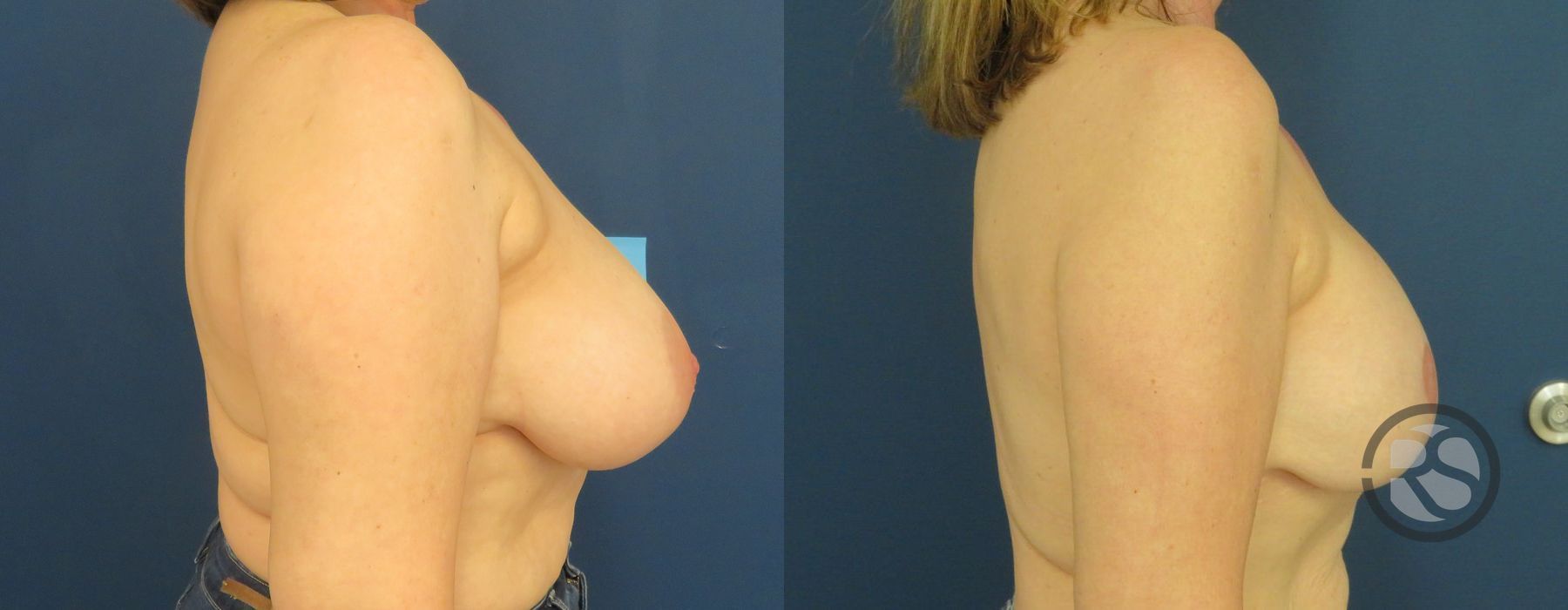 Before photo - Angle 3