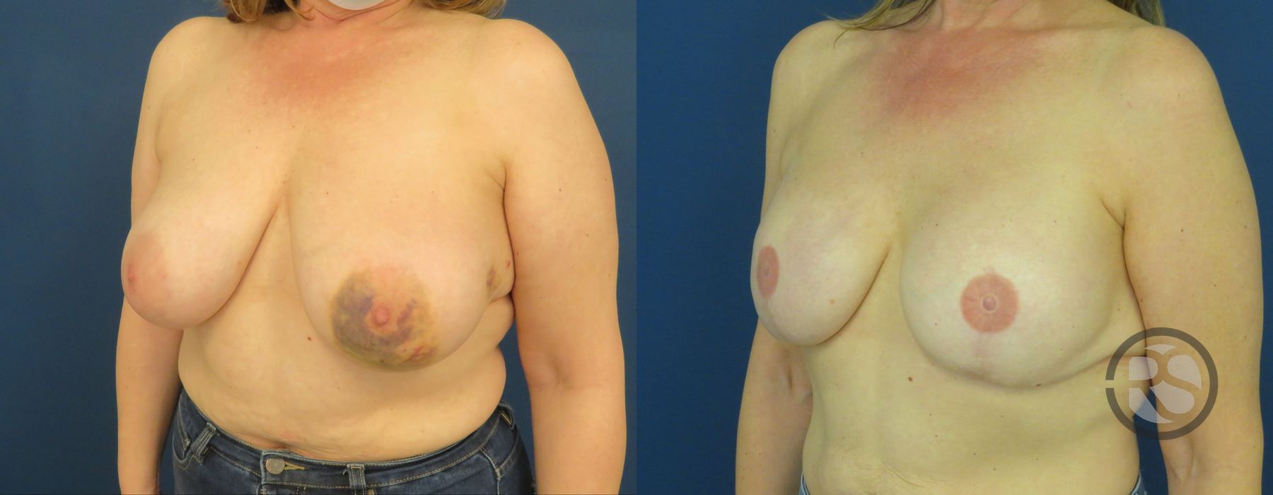 Before photo - Angle 4