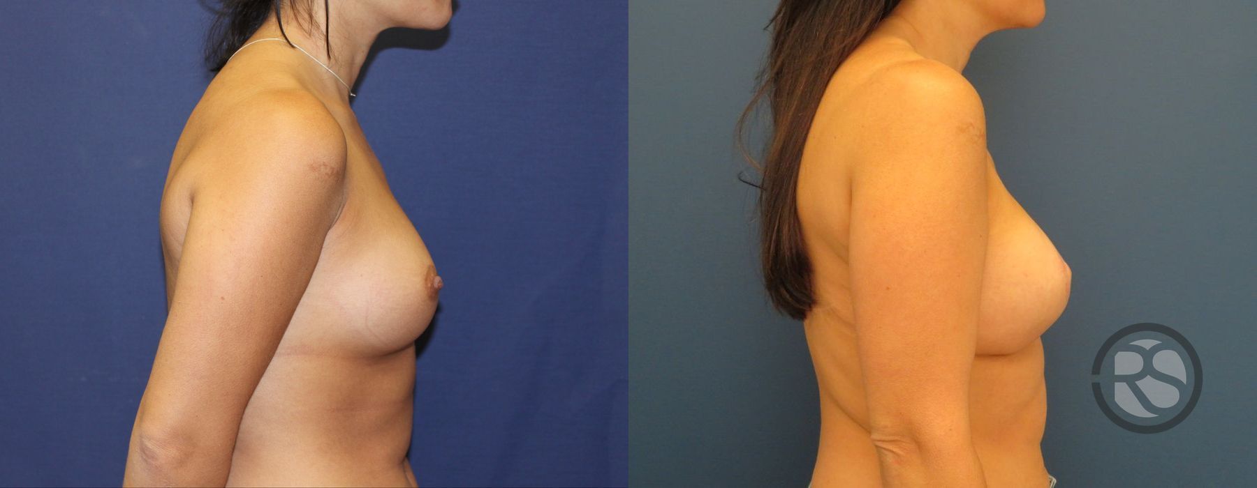 Before photo - Angle 3