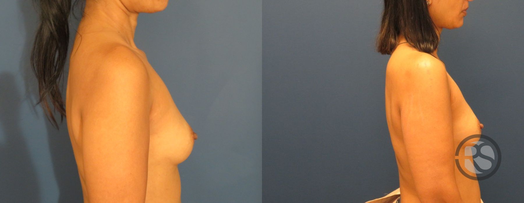 Before photo - Angle 3