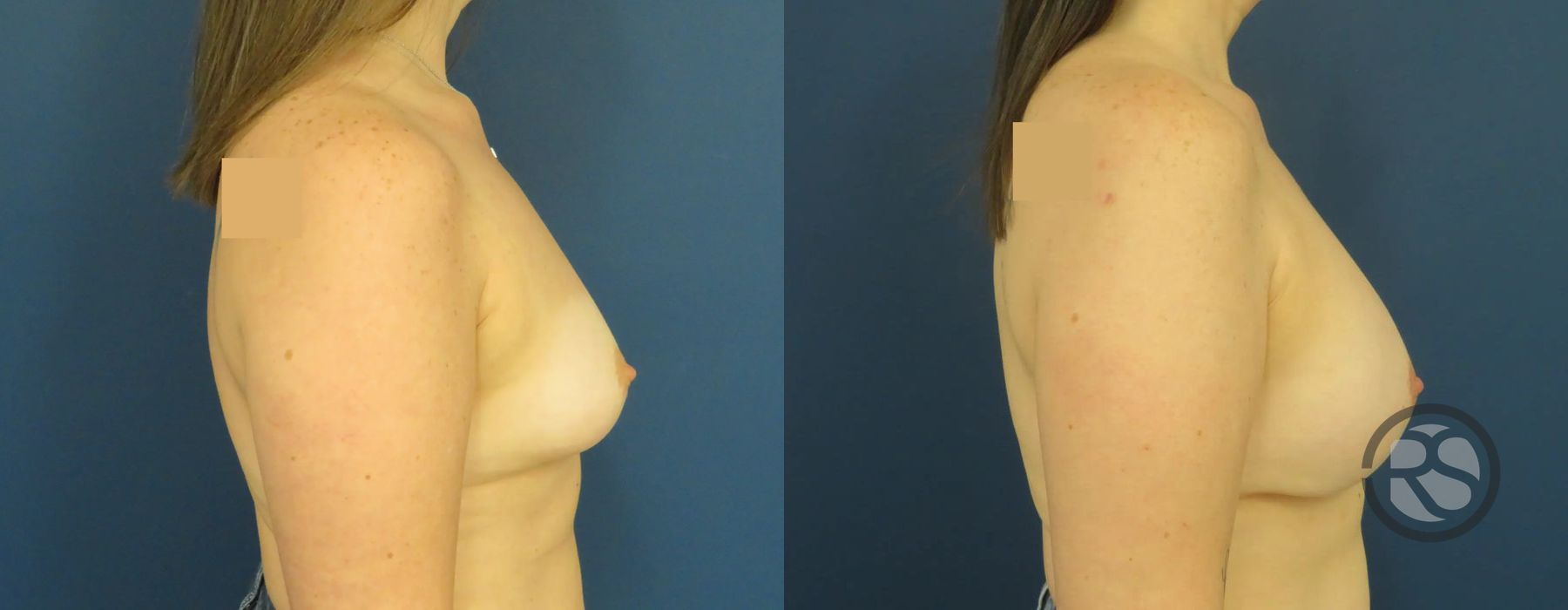 Before photo - Angle 3