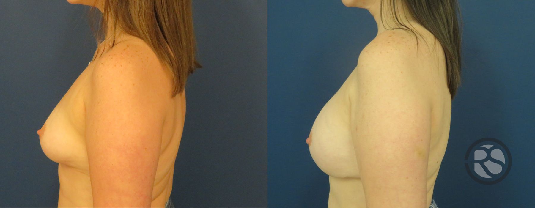 Before photo - Angle 5