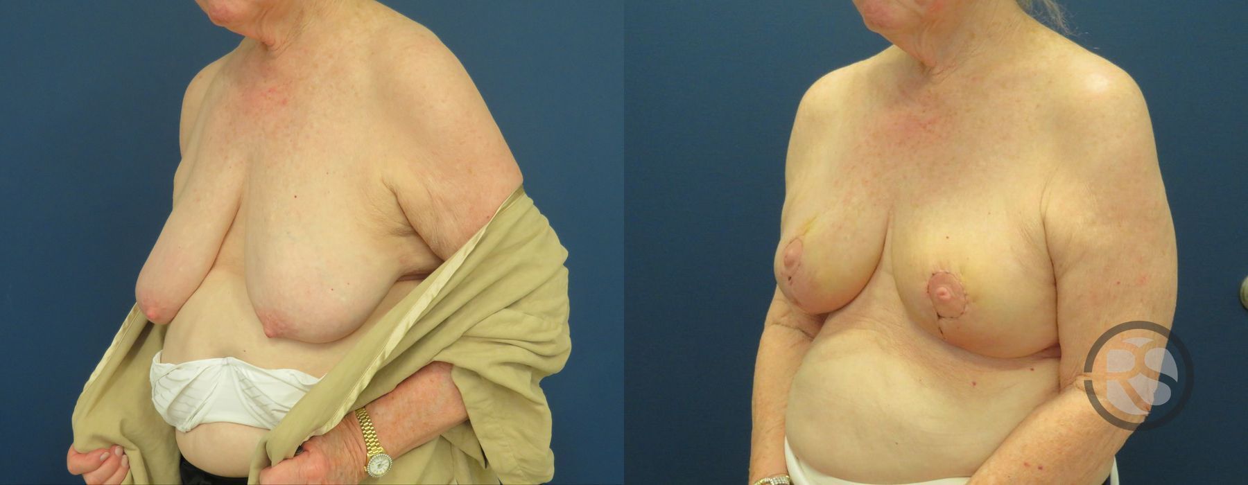 Before photo - Angle 4