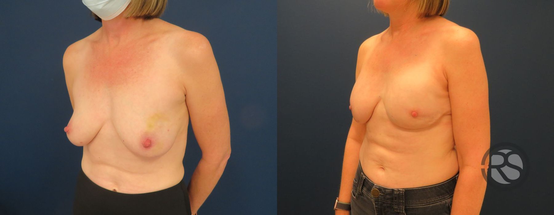 Before photo - Angle 4