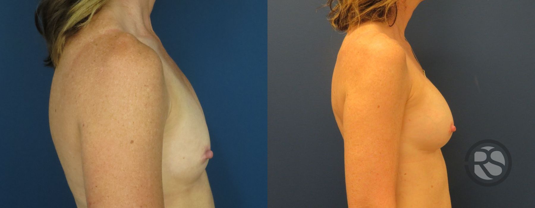 Before photo - Angle 3