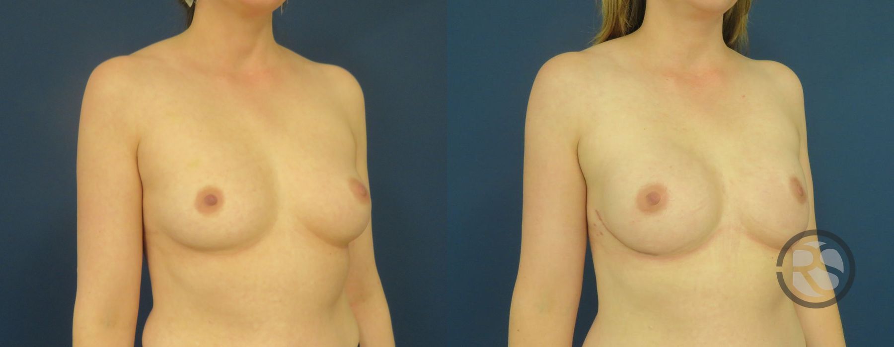 Before photo - Angle 2