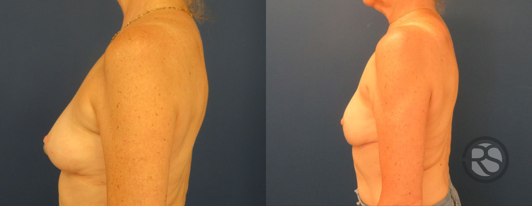 Before photo - Angle 5