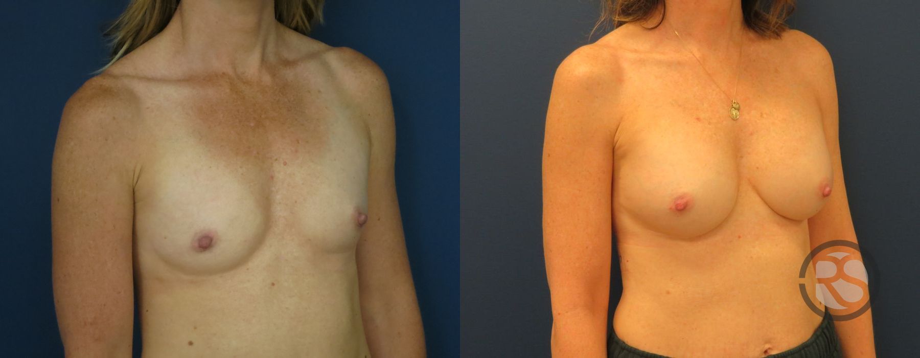 Before photo - Angle 2