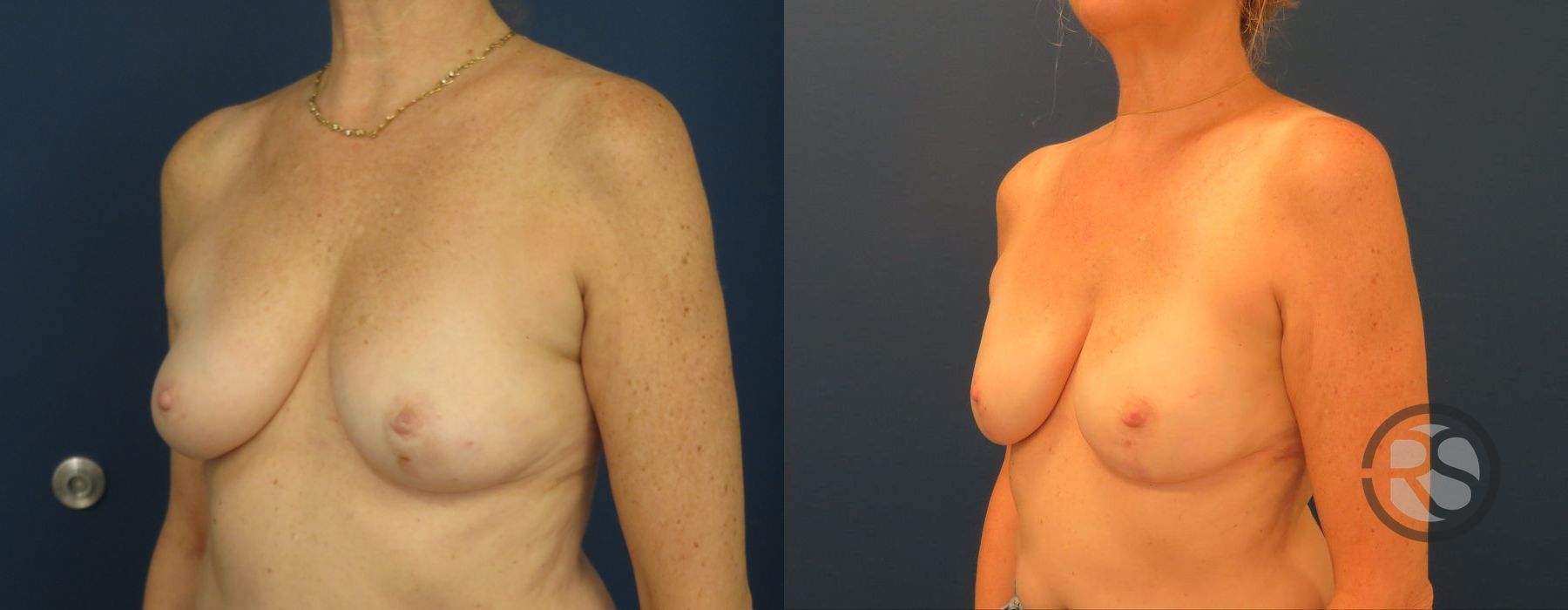 Before photo - Angle 4