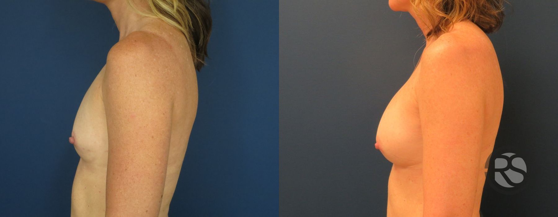 Before photo - Angle 5