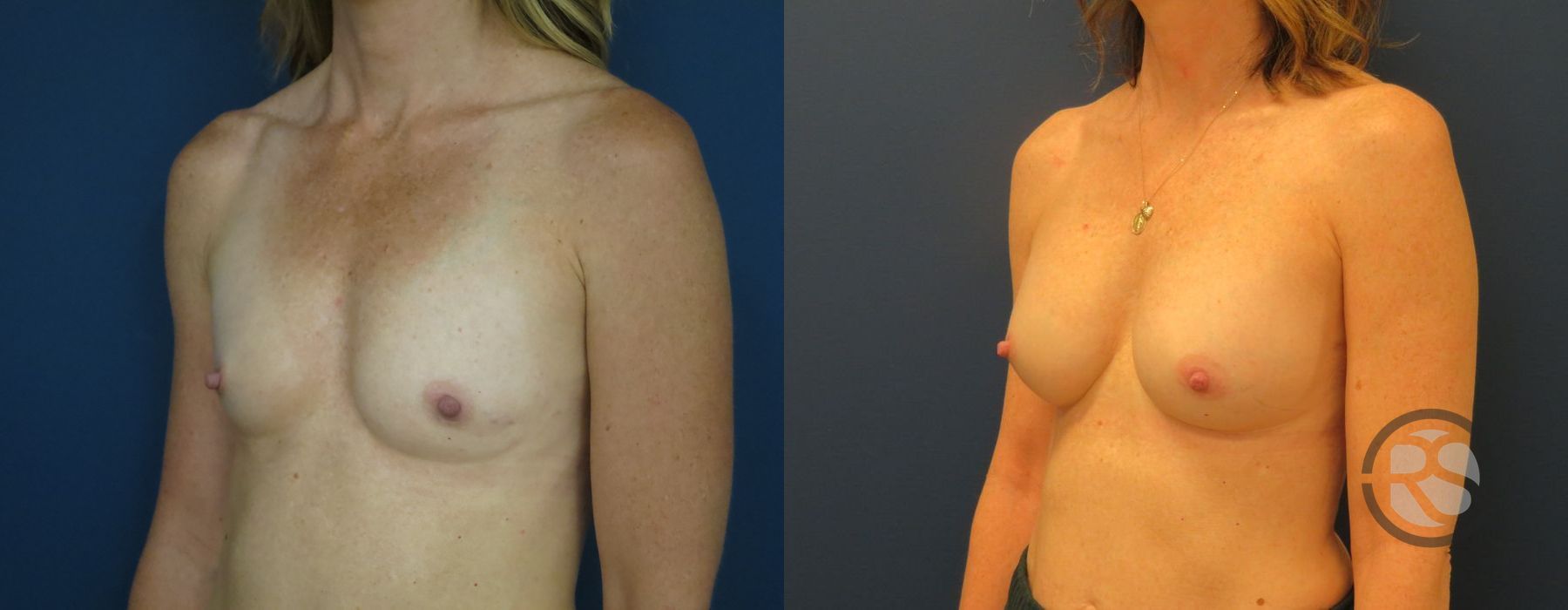 Before photo - Angle 4