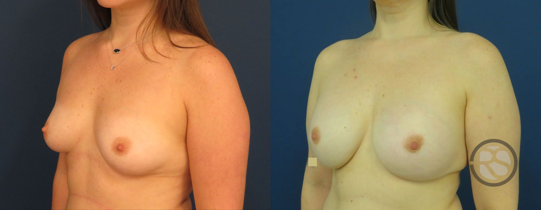 Before photo - Angle 4