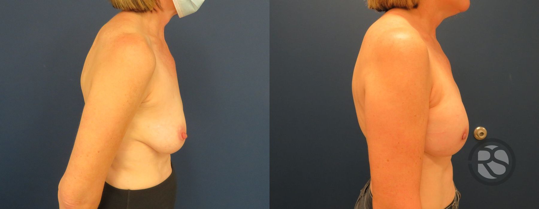 Before photo - Angle 3