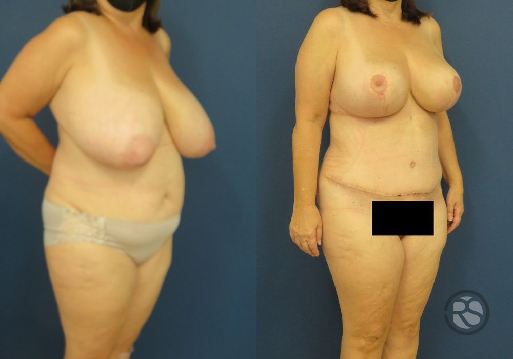 Before photo - Angle 2