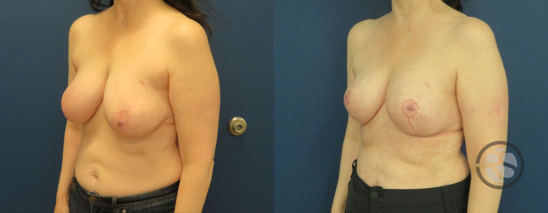 Before photo - Angle 2