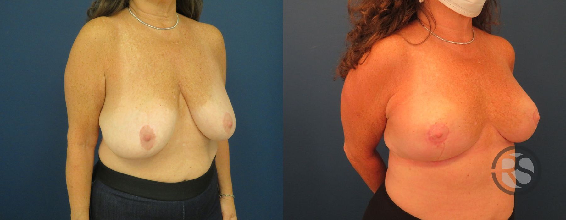 Before photo - Angle 4