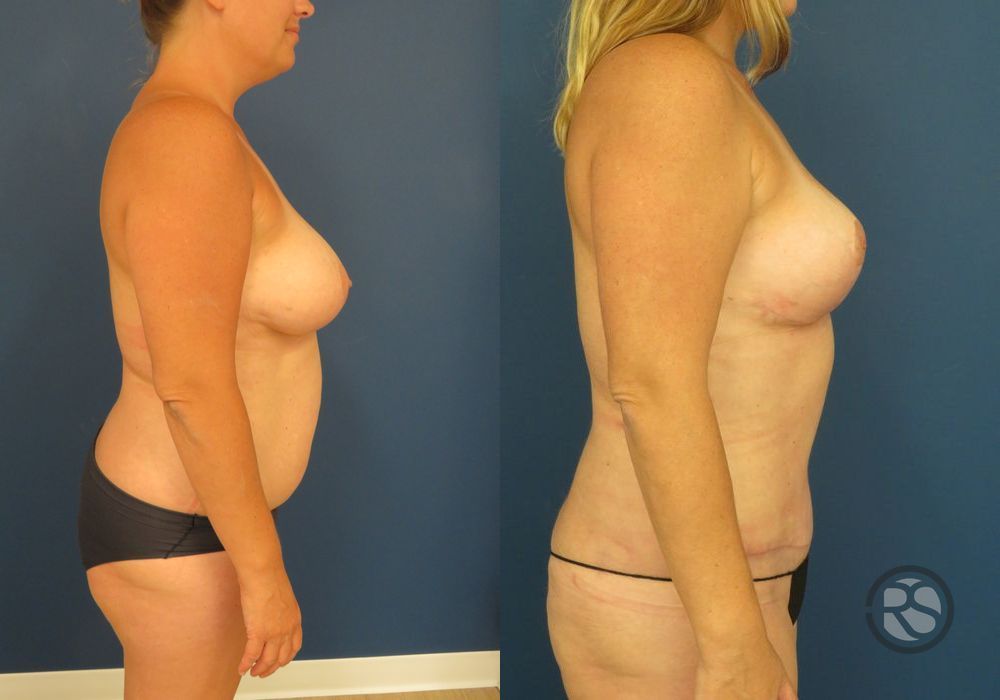 Before photo - Angle 3