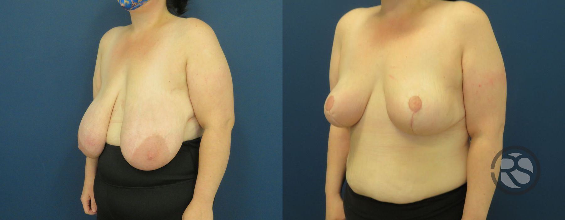 Before photo - Angle 4