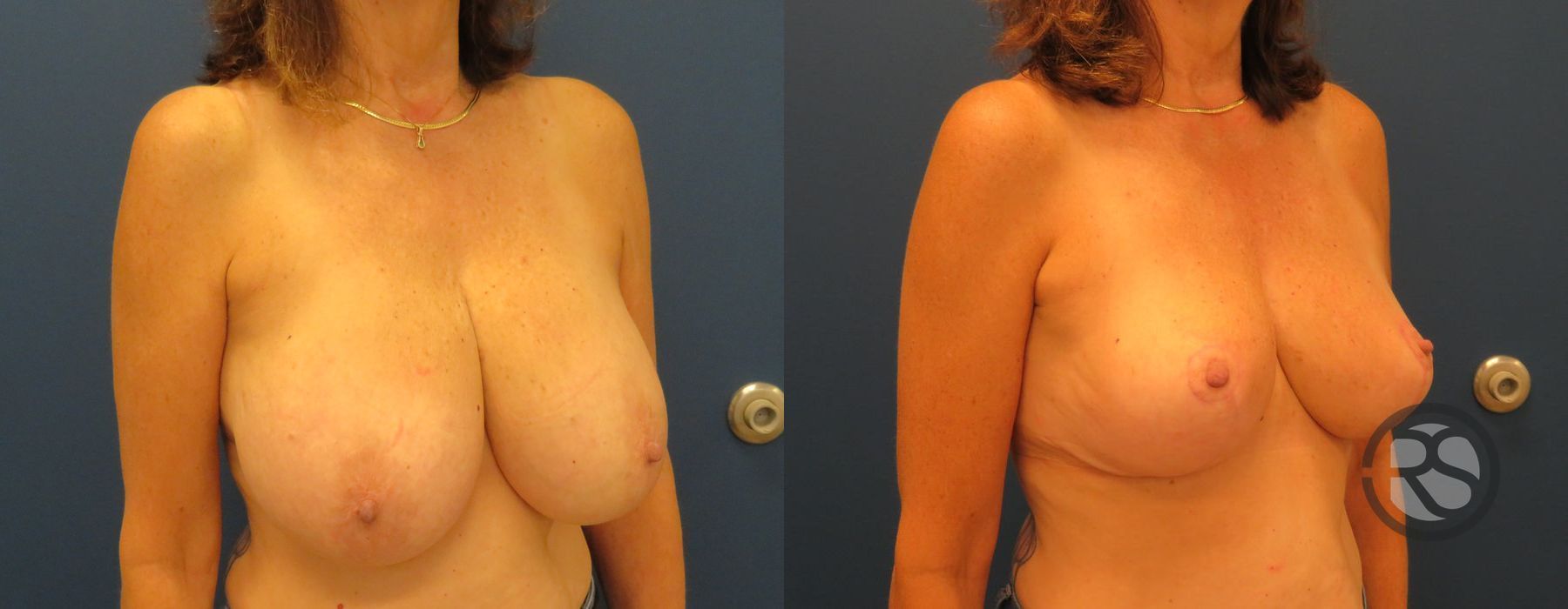 Before photo - Angle 2