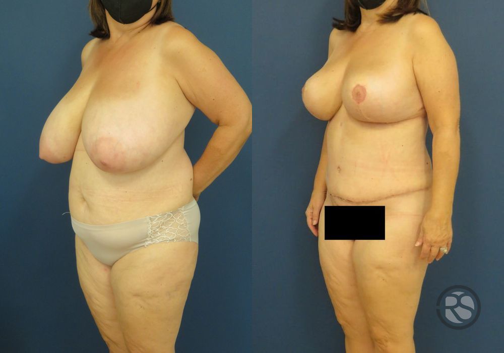 Before photo - Angle 4