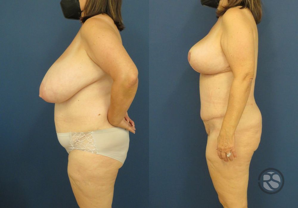 Before photo - Angle 5