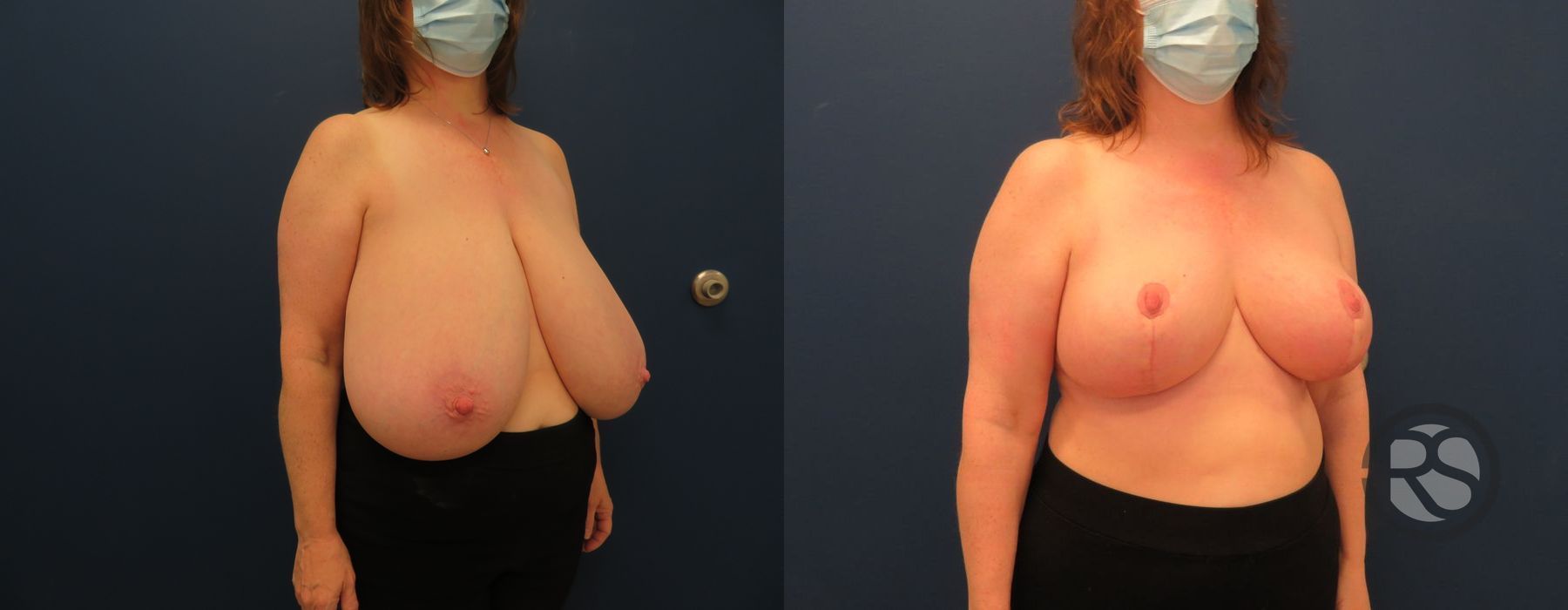 Before photo - Angle 2