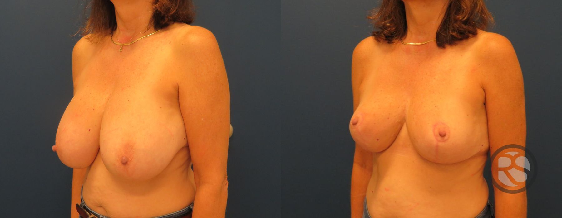 Before photo - Angle 4