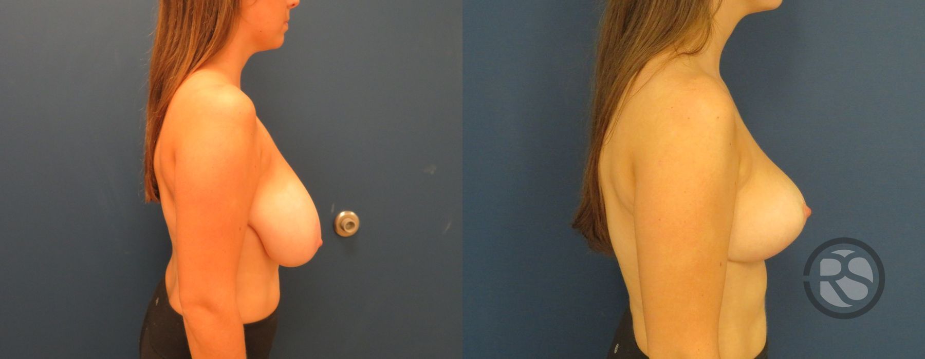 Before photo - Angle 3