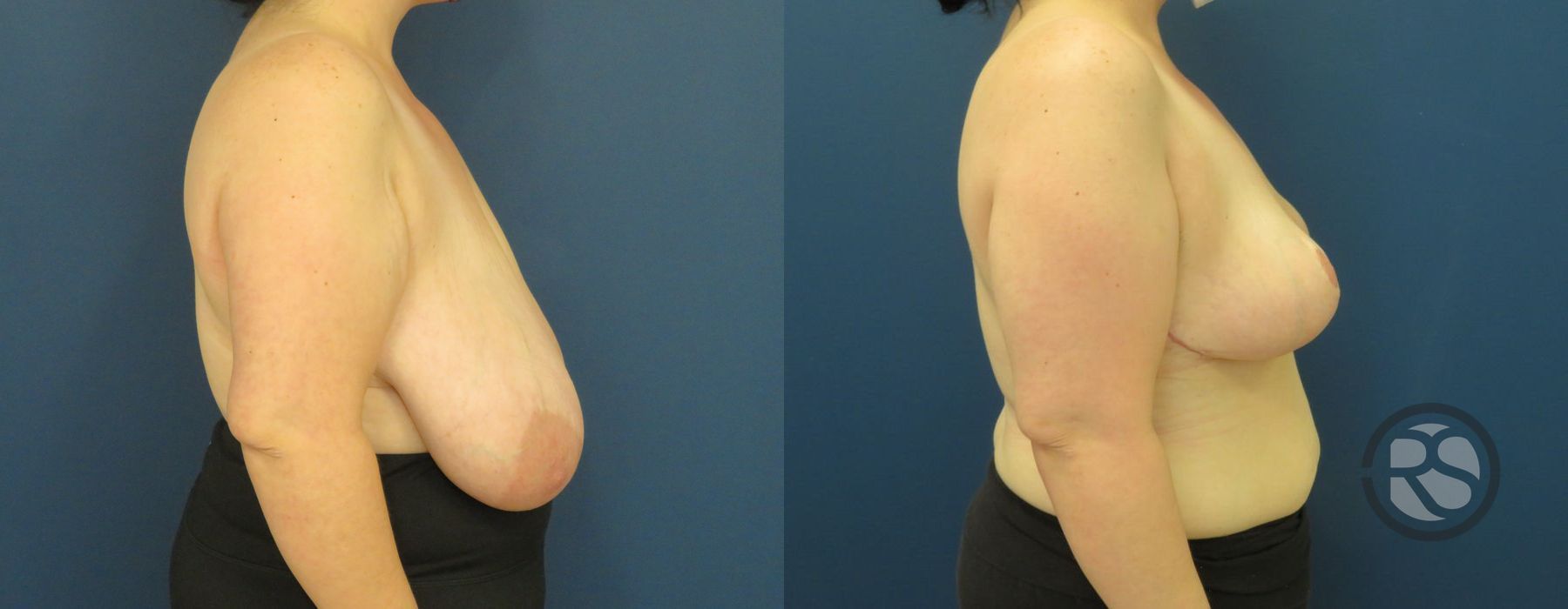 Before photo - Angle 3