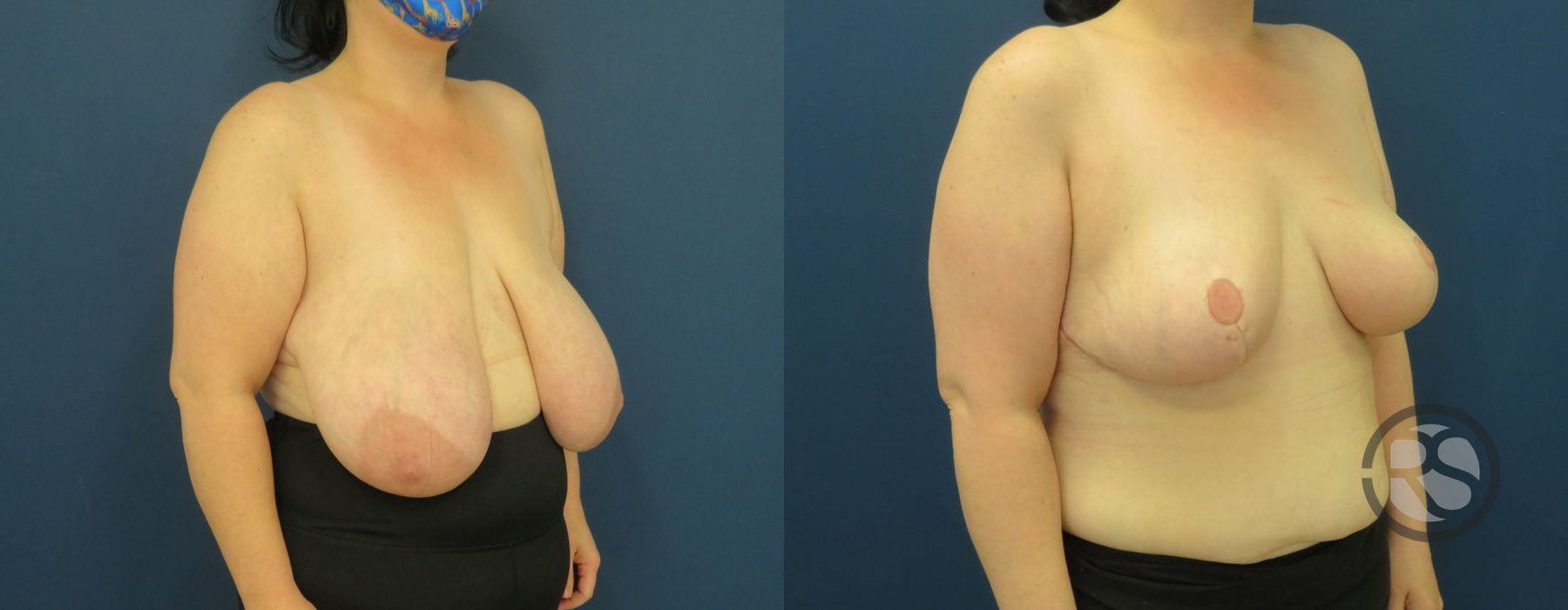 Before photo - Angle 2