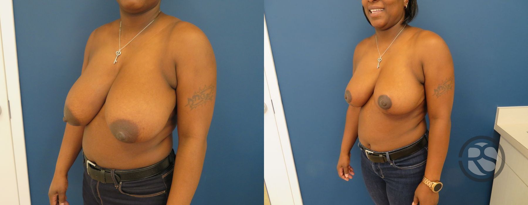 Before photo - Angle 4