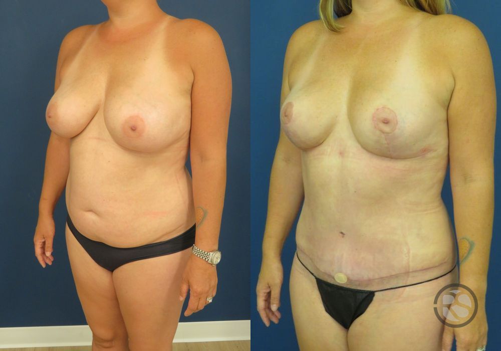 Before photo - Angle 4