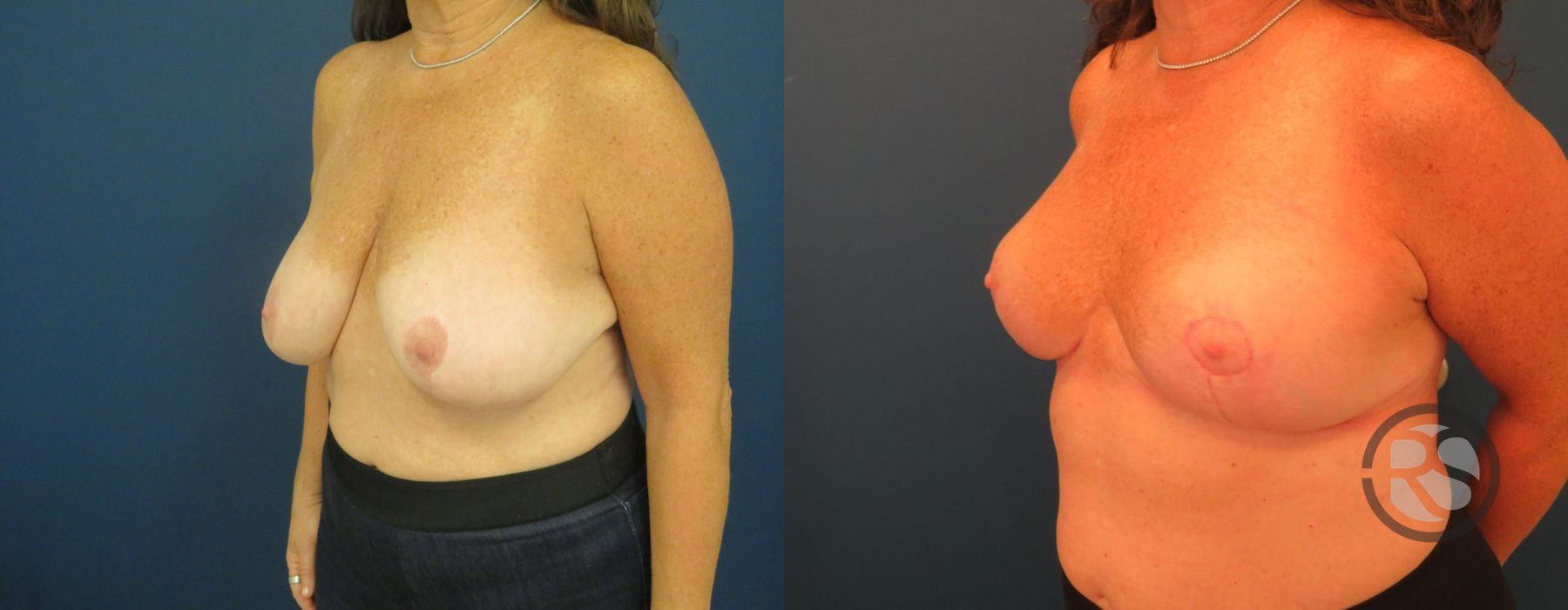 Before photo - Angle 2