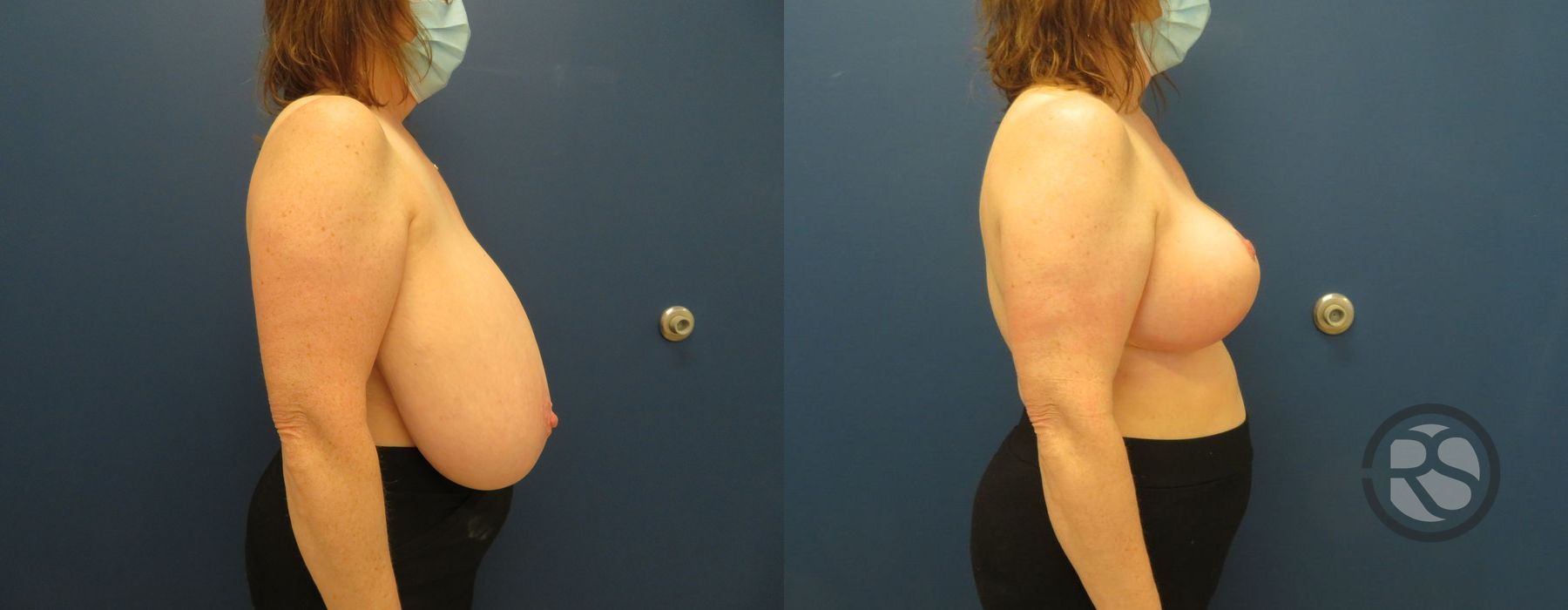 Before photo - Angle 3