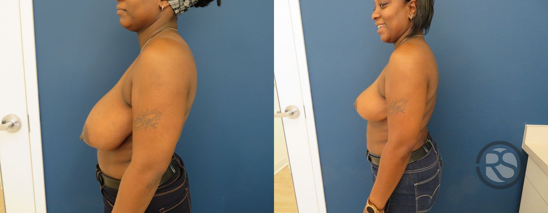 Before photo - Angle 5