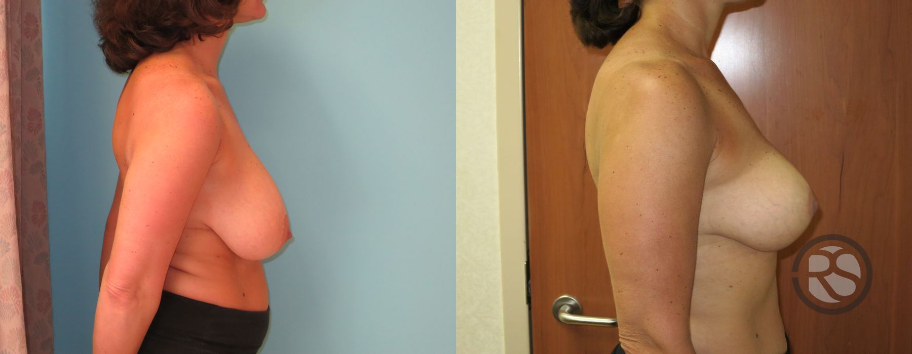 Before photo - Angle 3