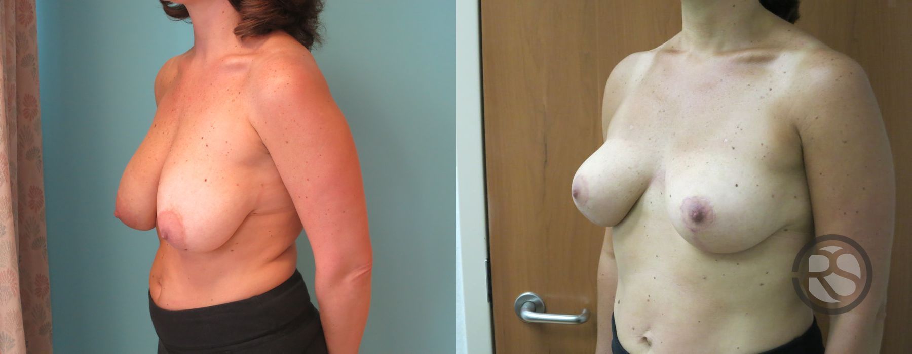 Before photo - Angle 4