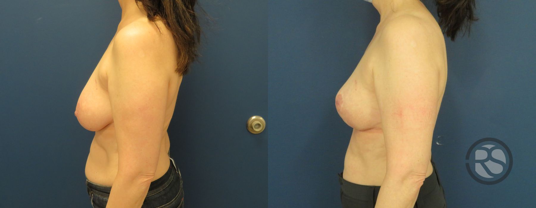 Before photo - Angle 3