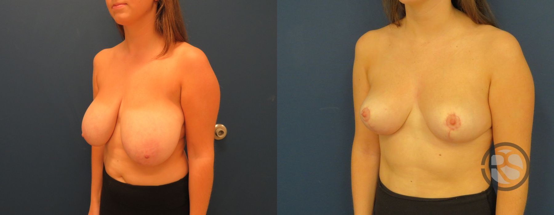 Before photo - Angle 4